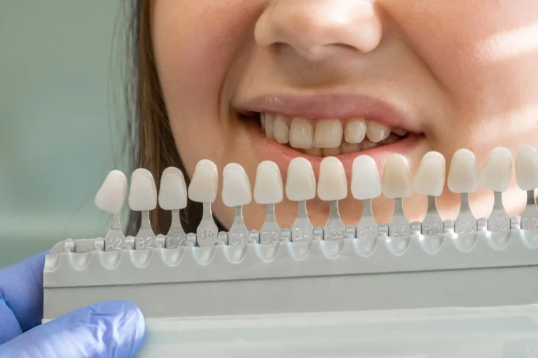 Come cambiano i denti con le faccette dentali Come cambiano i denti con le faccette dentali