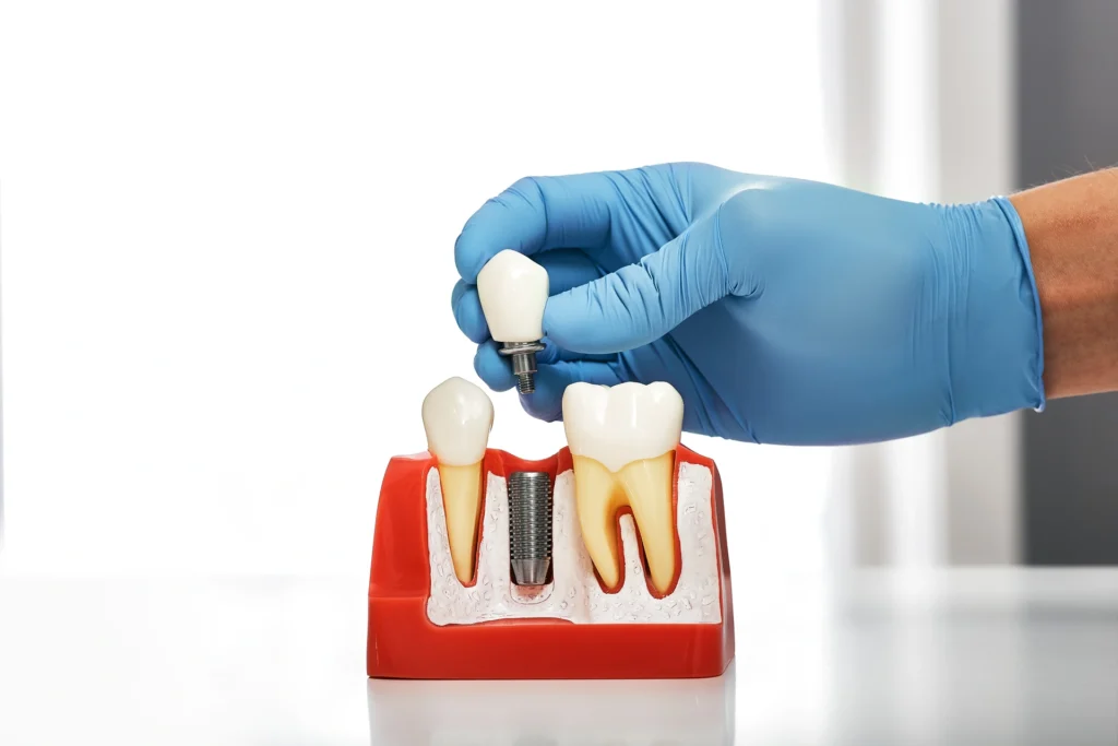 Come funziona un impianto dentale