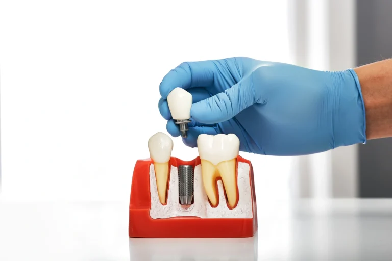 Come funziona un impianto dentale Come funziona un impianto dentale